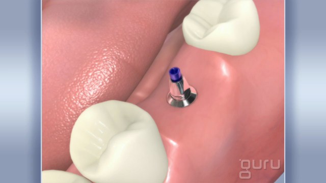 Implant Molar